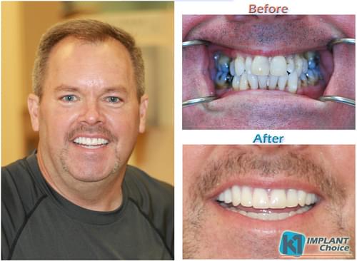 K1 Implant Choice All on 4 full mouth dental implants in one day