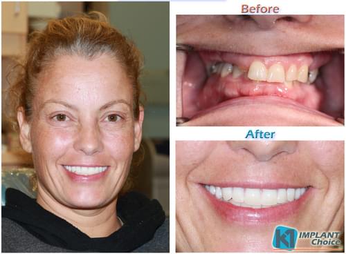 K1 Implant Choice All on 4 full mouth dental implants in one day