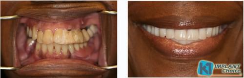 K1 Implant Choice All on 4 full mouth dental implants in one day