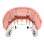 K1 Implant Choice All on 4 full mouth dental implants in one day
