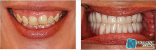 K1 Implant Choice All on 4 full mouth dental implants in one day